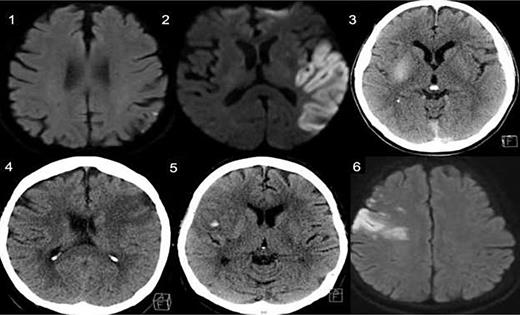 Representative CT (3, 4, 5) or magnetic resonance imaging (1, 2, 6) 24 h after reperfusion therapy in each case scenario presented to the participants.