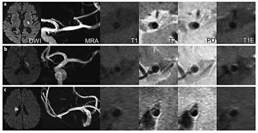 Fig. 1. Imaging findings of 3 patients with branch atheromatous MCA plaques. a Patient 4: DW image with a focal high signal intensity lesion in the internal capsule, MRA without significant stenosis in the MCA, and T1, T2, PD, and T1E images demonstrating atheromatous plaque at ventral MCA with subtle enhancement. b Patient 5: DW image with a focal lesion in basal ganglia, normal MCA by MRA, and T1, T2, PD, and T1E images showing atheromatous plaque at the superior MCA with enhancement. c Patient 6: DW image with a focal corona radiata lesion, normal MCA by MRA, and T1, T2, PD, and T1E images showing atheromatous plaque at the ventrosuperior portion of the MCA with enhancement.