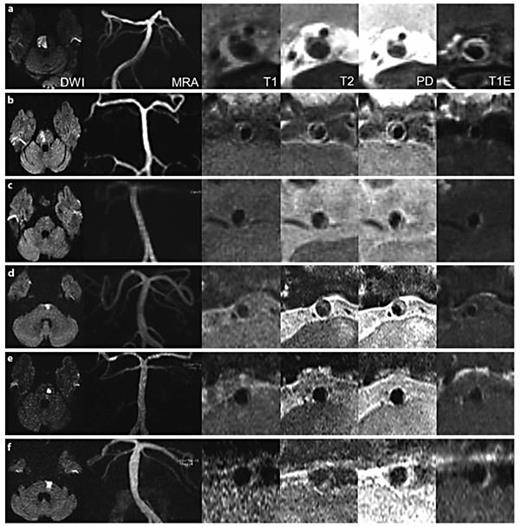 Fig. 2. Image findings of 6 patients with branch atheromatous plaque in the BA. a Patient 10: DW image showing a high signal intensity lesion in the right pons extending to the base surface, MRA showing no significant stenosis in the BA, and T1, T2, PD, and T1E images demonstrating atheromatous plaque at the ventrolateral portion of the BA with enhancement. b Patient 11: DW image showing a focal lesion in the right pons extending to the base surface, MRA showing a normal BA, and T1, T2, PD, and T1E images demonstrating atheromatous plaque at the lateral BA with enhancement. c Patient 12: DW image showing a focal lesion in the left pons extending to the base surface, MRA showing a normal BA, and T1, T2, PD, and T1E images demonstrating atheromatous plaque at the dorsolateral BA encroaching a perforating artery orifice with enhancement. d Patient 13: DW image showing a high signal intensity lesion in the left pons extending to the base surface, MRA showing no significant stenosis in the BA, and T1, T2, PD, and T1E images demonstrating atheromatous plaque at the ventrolateral BA with enhancement. e Patient 14: DW image showing a focal isolated lesion in the left pons, MRA showing a normal BA, and T1, T2, PD, and T1E images demonstrating small atheromatous plaque at the lateral BA with enhancement. f Patient 15: DW image showing a focal lesion in left pons extending to the base surface, MRA showing a normal BA, and T1, T2, PD, and T1E images demonstrating atheromatous plaque at the dorsolateral BA with enhancement.