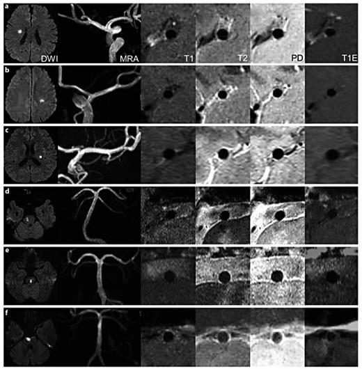 Fig. 3. Imaging findings of 6 patients without branch atheromatous plaque in the MCA or BA. a–c Patients 1–3: DW images showing a focal high signal intensity lesion in the right corona radiata, left corona radiate, and left basal ganglia, and MRA showing a normal MCA. d–f Patients 7–9: DW image showing a focal isolated lesion in the right pons, left pons, and right pons extending to the basal surface, and an MRA showing no significant stenosis in the BA. All HR-MRI sequence, T1, T2, PD, and T1E images demonstrating normal vessel walls without enhancement.