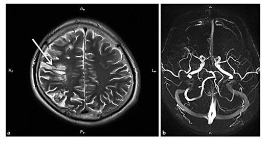 Fig. 1. a Patient R., 52 years. Massive right-hemispheric infarction due to thrombotic occlusion of the ICA (first 24 h). b Same patient. Blood flow recovery in the right middle cerebral artery (MR angiography, 48 h after stroke).