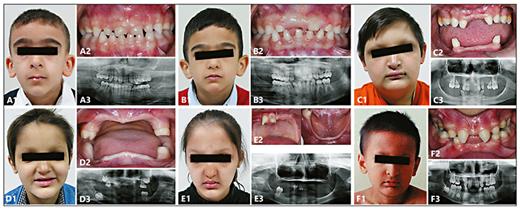 Clinical photographs and radiographs. Frontal facial view (1), intraoral view (2), and panoramic radiograph (3). A, B WNT10A_F2 siblings showing normal primary dentition and severely affected permanent dentition. C EDA_F3 proband showing facial dysmorphism and severe oligodontia. D, E EDARADD_F1 siblings showing severe facial dysmorphism and severe oligodontia. F EDAR_F5 proband showing moderate oligodontia.
