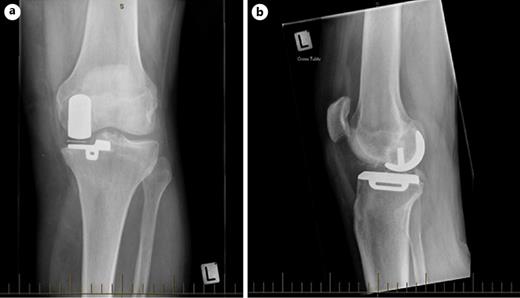 Fig. 2. a, b AP and lateral imaging preoperatively showing the polyethylene liner has rotated back into the correct position, note the mediolateral direction of the metallic marker.