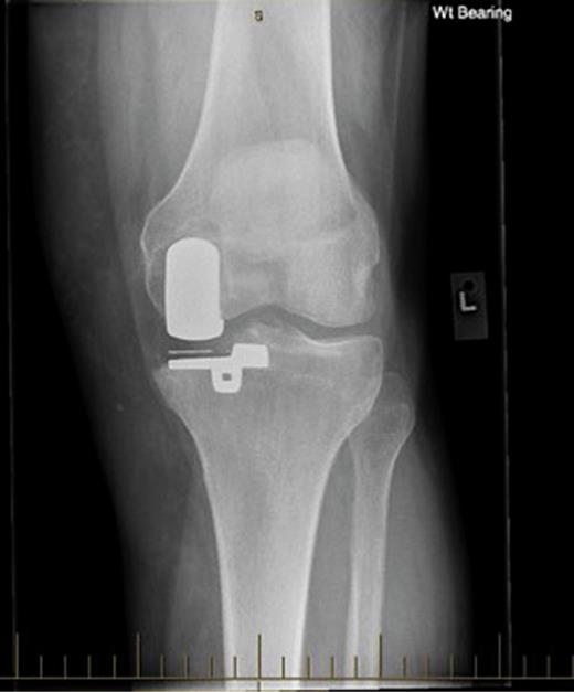 Fig. 4. a Postoperative imaging at 2 years showing correct positioning of the polyethylene liner, note the mediolateral direction of the metallic marker.