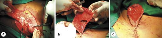 Fig. 2. a Raise of the flap. b Highlighting of the superficial circumflex iliac artery in the center of the flap (arrow). c Tubing of the flap base.