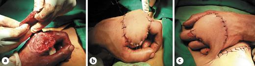 Fig. 3. a–c Coverage of the defect by the flap.