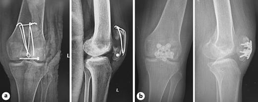 Fig. 2. a Radiographs showing cutout of TBW following re-trauma to the same, previously operated knee. The lower fragment was maintained as a single fragment with CCS in situ. b Postoperative radiographs showing fixation of the patella fracture with star-shaped locking patella plate.