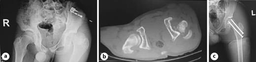 Fig. 1. a Pelvic X-ray and pelvic CT scan (b) revealed Delbet type 1B fracture of the left femoral neck. c Fixation with two 6.5-mm cannulated screws.