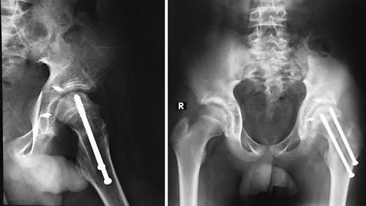 Fig. 2. Occurrences of AVN 8 months after the trauma.