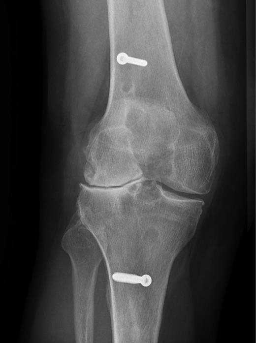 Fig. 1. Preoperative radiograph.