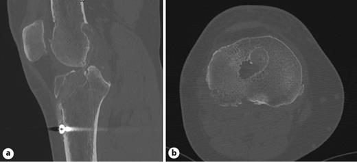 Fig. 2. a Sagittal CT demonstrating osteolysis. b Axial CT demonstrating tunnel widening and osteolysis.