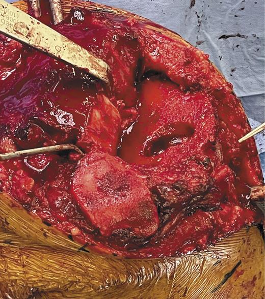 Fig. 3. Intraoperative extent of tibial osteolysis.