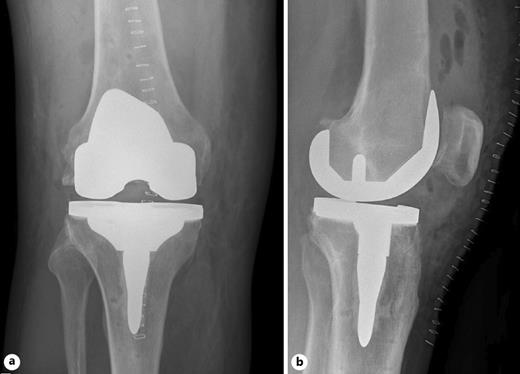 Fig. 4. Post-operative radiograph. a anteroposterior. b lateral.