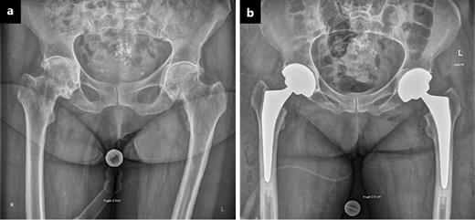 Fig. 1. Anteroposterior pelvic radiographies pre- (a) and post-operatively after bilateral THA having been performed (b). Clearly visible is a post-operative extension position of the pelvis, with reduced craniocaudal diameter of the obturator foramina, despite release of the anterior soft tissues at the level of the hip joints.