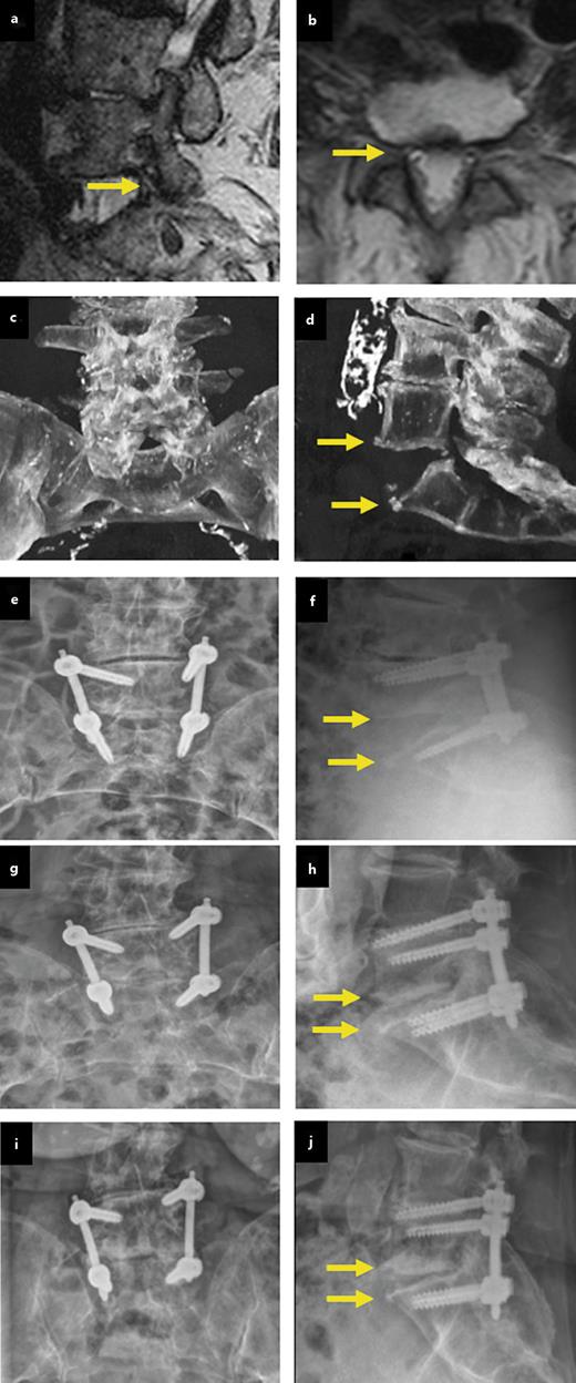 Fig. 3. Magnetic resonance imaging of the lumbar spine in sagittal (a) and axial (b) views. The facet joints appeared intact, but degenerative neuroforaminal stenosis was present bilaterally with contact with the L5 roots (yellow arrows). Initial computed tomography using multiplanar reconstruction of the lumbar spine in coronal (c) and sagittal (d) views, demonstrating acute rupture of the ligament sheath and the posterior ligaments in segment L5-S1 (yellow arrows). A thick slice reconstruction was chosen to provide images similar to the conventional radiographs provided from follow-up. Zone of interest of anteroposterior (e) and lateral (f) radiographs of the lumbar spine, showing the lumbosacral junction, following L5-S1 spondylodesis. Some displacement in extension (yellow arrows) was accepted to reduce consecutive risk of nerve root compression, respectively, requirements for facet joint resection. Anteroposterior (g) and lateral (h) lumbar radiographs at the 8-week follow-up. Note the return of the vertebral body of L5 in an anatomic position to S1 (yellow arrows), with now anatomical tilting of the pelvis. Anteroposterior (i) and lateral (j) lumbar radiographs at the 1-year follow-up. No further change in the implant position was observed.