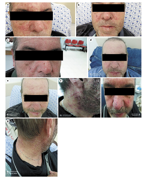 Acupuncture in the Treatment of Panitumumab Skin Toxicity: A Case ...