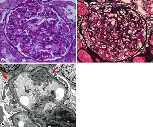 Fig. 1. Pathological findings of renal biopsy. a Light microscopy reveals 29 glomeruli, none of which are globally or segmentally sclerotic. Glomeruli show up to mild mesangial proliferation. Left: Periodic acid-Schiff stain (original magnification, ×400). Right: Periodic acid-methenamine-silver stain (original magnification, ×400). b Electron microscopy shows diffuse effacement of the foot processes (↑, arrowed line), with no electron-dense material in the mesangium (original magnification, ×3,000).