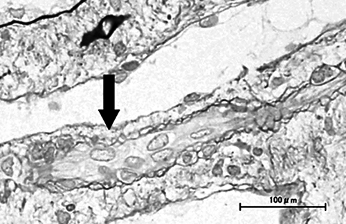 Fig. 2. Kidney biopsy specimen findings. Mild interstitial edema and vascular lumen narrowing by endothelial cell swelling (arrow) were detected (periodic acid-methenamine silver stain). No other abnormalities were found, including signs of acute tubular necrosis.