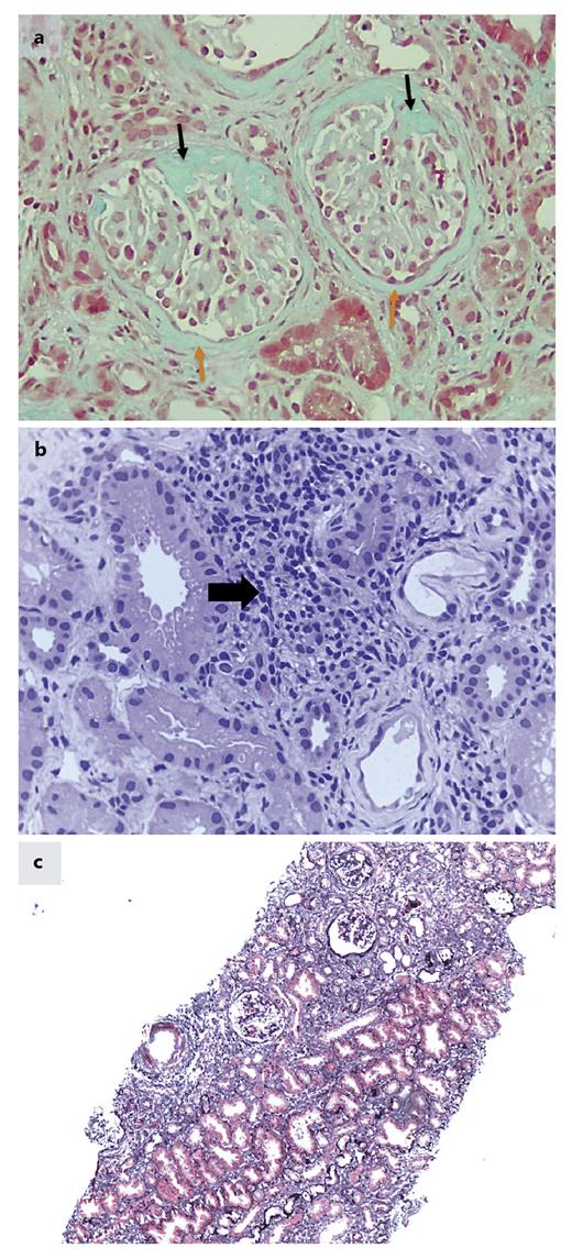 Fig. 2. a Histopathologic findings of case 1. Two of the nine glomeruli showing partial sclerosis (black arrows), out of a total of 58 glomeruli identified at all levels (Masson’s trichrome, ×400 magnification). Thickening of Bowman’s capsule can also be seen (orange arrows). b Histopathologic findings of case 1. Interstitial infiltration of mononuclear inflammatory cells (black arrow, H&amp;E, ×400 magnification). c Histopathologic findings of case 1. Geographical fibrosis is also present (Silver trichrome, ×100 magnification).