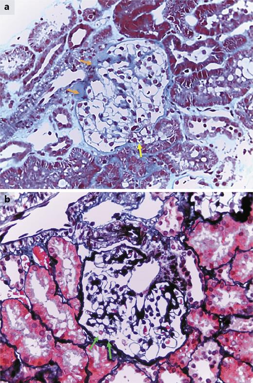 Fig. 3. a Histopathologic findings of case 2. A small area of hyalinization in one glomerulus (orange arrow) and adhesion of glomerular tuft to the tubular pole (yellow arrow) can also be seen (Masson’s trichrome; ×400). These features represent early focal segmental glomerulosclerosis. b Histopathologic findings of case 2. There is a subtle adhesion of the glomerulus to Bowman’s capsule near the tubular pole (green arrows), suggesting early segmental glomerulosclerosis (Silver trichrome, ×400 magnification).