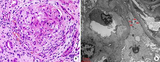 Kidney biopsy findings. a Light microscopy displaying crescent formation in a glomerulus (periodic acid-Schiff; original magnification, ×400). b Ultrastructural examination using electron microscopy presenting diffusely effaced epithelial cell foot processes (red arrows).