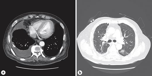 Chest CT images from November 3rd, 2022. a Right pleural effusion; pigtail catheter inserted. b Irregular consolidation and ground-glass opacities in the superior segment of the left lower lobe.