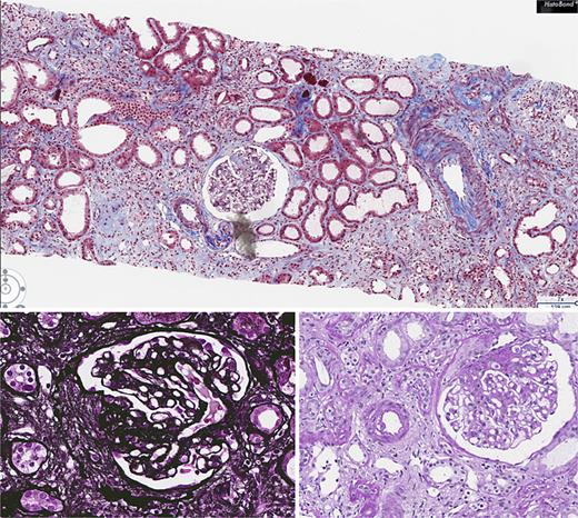 Pathological findings of renal biopsy.