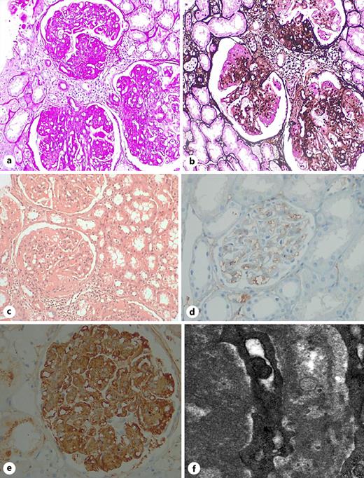 Kidney biopsy sections demonstrating periodic acid-Schiff-positive (a), Jones’ methenamine silver-negative (b), and Congo red-negative (c) mesangial and capillary wall deposits (all ×200 magnification). d Immunohistochemistry staining for fibronectin 1 with a monoclonal mouse-origin antibody (clone 568) in a normal glomerulus. e Immunohistochemistry staining for fibronectin 1 with a monoclonal mouse-origin antibody (clone 568) demonstrating strong positivity of the mesangial and capillary wall deposits in the present case (×400 magnification). f EM section demonstrating finely granular electron-dense deposits corresponding to the periodic acid-Schiff positive deposits shown via LM (×12,000 magnification).