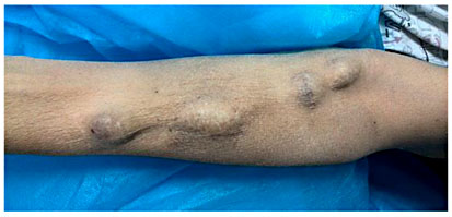 Fig. 1. Enlargement and aneurysmal dilatation of the venous system of the left forearm.
