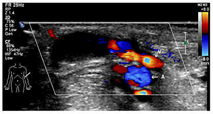 Fig. 2. Abnormal fistulae were detected by vascular ultrasound between the matured cephalic vein and the radial vein where blood shunt existed.