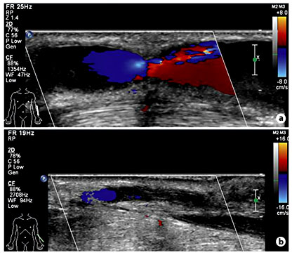 Fig. 3. Aneurysmal dilatation in the distal segment of the cephalic vein (a) and thrombus in the proximal cephalic vein detected by vascular ultrasound (b).