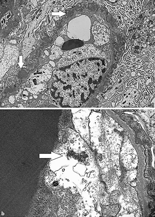 Tubuloreticular Inclusions in the Absence of Systemic Lupus ...