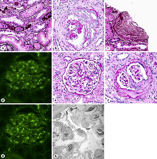 Fig. 1. Biopsy findings in patient showing predominant anti-neutrophil cytoplasmic antibody renal vasculitis and mild immune complex deposition possibly due to circulating cryoglobulin immune complexes. a Acute tubular necrosis, light microscopy. b Example of acute cellular crescent, light microscopy. c Intimal fibrosis, light microscopy. d Mesangial IgM deposition, immune fluorescence. e Mesangial proliferation, light microscopy. f Subacute fibro-cellular crescent, light microscopy. g Another view of immunofluorescence showing mild background IgM staining. h Electron micrograph showing no subendothelial electron-dense deposits typical of classical cryoglobulinemia.