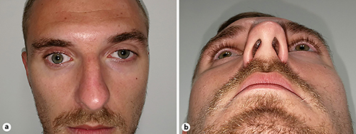 Fig. 1. a Preoperative frontal view of the patient showing right-sided hypoglobus, upper eyelid retraction, and deepening of the superior orbital sulcus. b Preoperative worm’s-eye view showing right-sided enophthalmos.