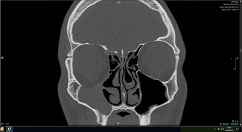 Fig. 2. Coronal CT scan showing orbital floor bowing and maxillary sinus opacification.