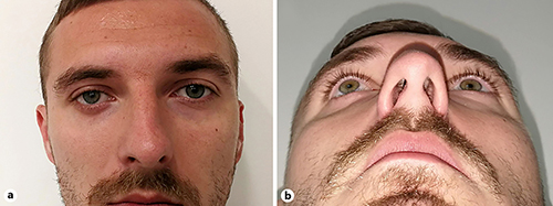 Fig. 3. Eight-week postoperative view. a Frontal view of the patient showing resolution of hypoglobus, upper eyelid retraction, and deepening of the superior orbital sulcus. b Worm’s-eye view showing resolution of right-sided enophthalmos.