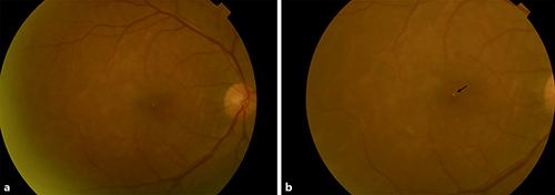 Fig. 1. a Colour fundus photograph of the right eye at the first post-operative review demonstrating a well-defined yellow foveal appearance with a bubble of retained C3F8. b Magnified image of the macula focusing anteriorly on the bubble itself (arrow). Notice that the bubble is trapped at the superior edge of the macular hole.