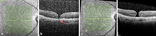 Fig. 2. Images at the 6-week post-operative review. a Infra-red image showing a hyporeflective foveal spot. b Cross-sectional SD-OCT through the fovea showing a full thickness macular hole. In addition, there is shadowing at the level of the choroid (red arrow) caused by the pre-retinal bubble of C3F8. c 12 weeks afetr RD repair showing absorption of the gas bubble and normal appearance of Bruch’s membrane and choroidal layers.