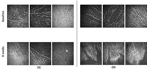Fig. 1. Picture from corneal nerves in a patient from the verum group staying on hyaluronic acid eye drops even after the study.
