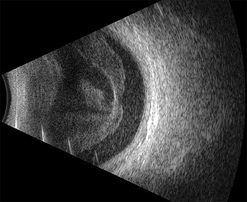 Fig. 1. B-scan 26 days after initial injury demonstrating total posterior vitreous detachment, choroidal thickening, and dense mobile subhyaloid and vitreous opacities indicative of endophthalmitis. There is no evidence of intraocular foreign body.