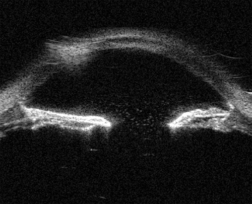 Fig. 2. Ultrasound biomicroscopy about 4 months after initial injury demonstrating retained lens capsule adherent to the posterior iris.