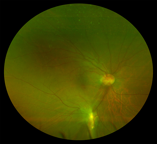 Fig. 3. Fundus photos 12 days post-vitrectomy demonstrating pre-retinal fibrosis and atrophy near the inferior vascular arcade.