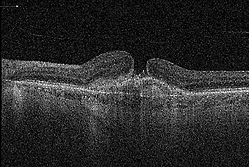 Fig. 1. OCT examination of the left eye. An MH and CNV are visible. Examination was performed on TOPCON Triton OCT.