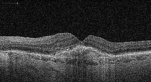 Fig. 2. OCT examination of the left eye after surgery. CNV is visible and the MH is closed. Examination was performed on TOPCON Triton OCT.