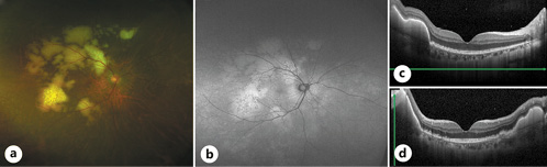 Fig. 1. a Fundus photograph showing subretinal yellowish lesions. b FAF showing hyperfluorescence lesions corresponding to the subretinal yellowish lesions. OCT showing a massive sub-RPE lesion and pre-RPE deposits (horizontal scan (c); vertical scan (d)). FAF, fundus autofluorescence; OCT, optical coherence tomography; RPE, retinal pigment epithelium.