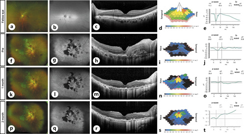 Fig. 2. Ophthalmologic examination of the unaffected eye (a–e), and the clinical course of PIOL treatment with intravitreal methotrexate (f–t). f Twelve months after the first visit, the subretinal yellowish lesion changed to an atrophic lesion and retinal hemorrhage occurred. g FAF showing change of the hyperfluorescence lesion to a hypofluorescence lesion. h OCT showing intraretinal infiltration, sub-RPE deposits, and disruption of the ellipsoid zone. mfERG showing severe attenuation of response density (i) and ffERG showing subnormal change compared with the unaffected eye (e, j). After treatment with ivMTX, retinal hemorrhage gradually disappeared (k, p). However, the hypofluorescence lesion did not change during the 2 months after starting treatment (l, q). OCT showed disappearance of intraretinal infiltration and recovery of the foveal ellipsoid and interdigitation zone (m, r). At the same time, mfERG showing recovery of central response density (n, s). However, the response of ffERG gradually decreased after treatment (o, t). PIOL, primary intraocular lymphoma; FAF, fundus autofluorescence; RPE, retinal pigment epithelium; OCT, optical coherence tomography; mfERG, multifocal electroretinogram; ffERG, full-field electroretinogram; ivMTX, intravitreal methotrexate.