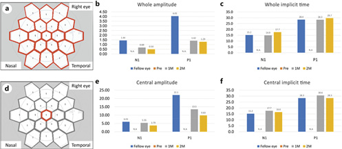 Fig. 3. mfERG recorded with skin electrodes at the center of the fovea covering a visual field of 30°. A response density of the whole area (a) and central area (d) were analyzed to compare the amplitude and implicit time before (Pre) and after treatment (1 and 2 months after treatments) (b, c, e, f). The implicit time of N1 and P1 recovered to levels as were seen for the unaffected eye (c, f). The amplitude of N1 and P1 did not reach the values as were seen for the unaffected eye (b, e). mfERG, multifocal electroretinogram.