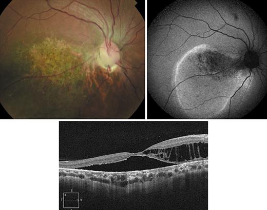 Fig. 6. Right eye morning glory disc anomaly with serous retinal detachment and retinoschisis shown on OCT.