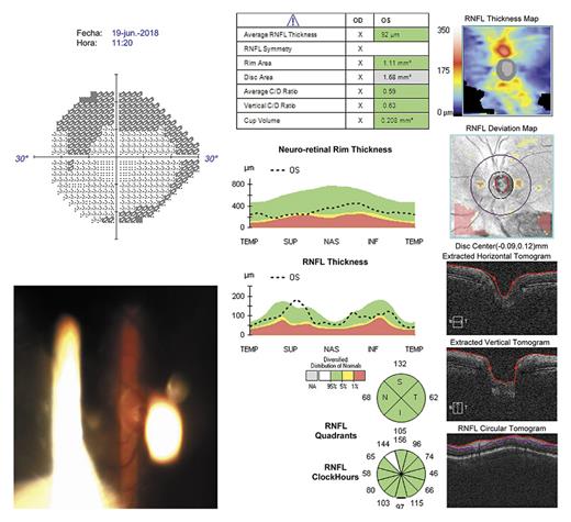 Fig. 1. VF, RNFL OCT images, and optic nerve photographs immediately after BKPro II implantation (June 2018). RNFL OCT: retinal nerve fiber layer optical coherence tomography.