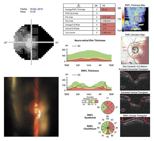 Fig. 2. VF, RNFL OCT images, and optic nerve photographs showing rapid deterioration 8 months after BKPro II implantation (February 2019). RNFL OCT: retinal nerve fiber layer optical coherence tomography.